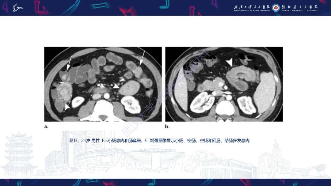 影像PPT - 【PPT】遗传性胃肠肿瘤综合征：影像学在筛查、诊断和治疗中的作用-26