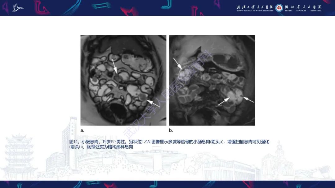 影像PPT - 【PPT】遗传性胃肠肿瘤综合征：影像学在筛查、诊断和治疗中的作用-27