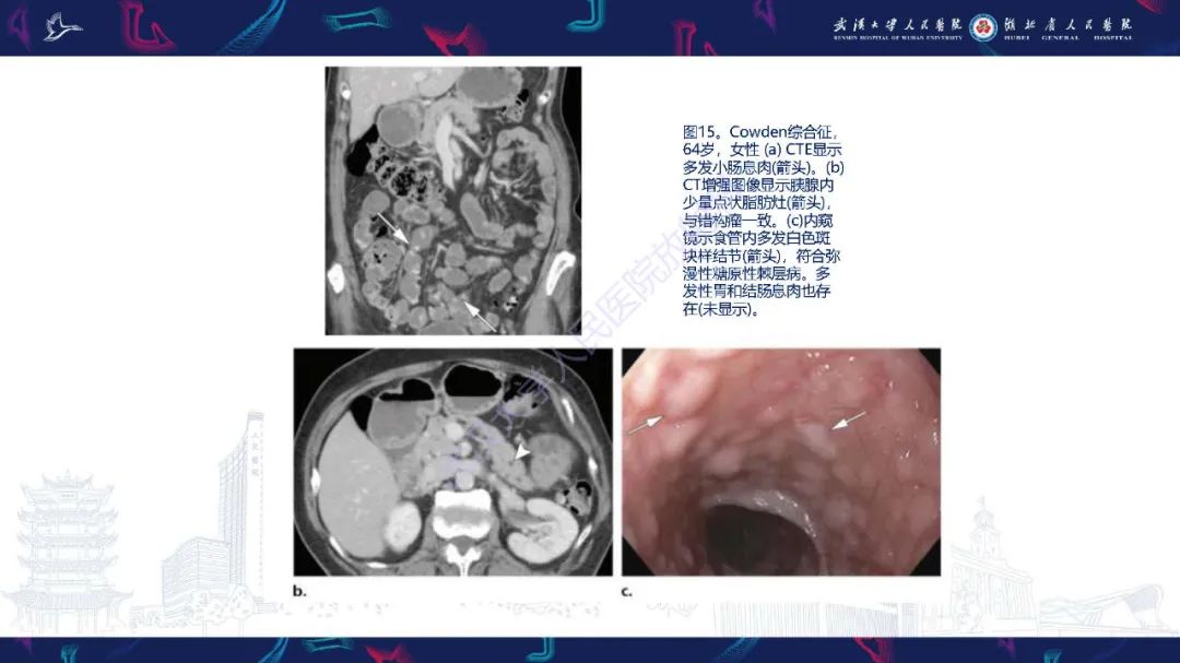 影像PPT - 【PPT】遗传性胃肠肿瘤综合征：影像学在筛查、诊断和治疗中的作用-31