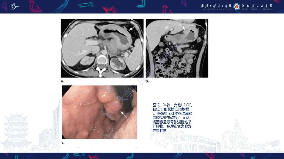 影像PPT - 【PPT】遗传性胃肠肿瘤综合征：影像学在筛查、诊断和治疗中的作用-34