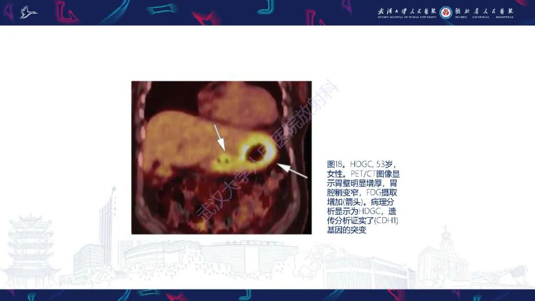 影像PPT - 【PPT】遗传性胃肠肿瘤综合征：影像学在筛查、诊断和治疗中的作用-35