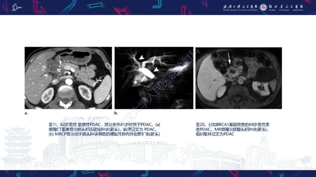 影像PPT - 【PPT】遗传性胃肠肿瘤综合征：影像学在筛查、诊断和治疗中的作用-38