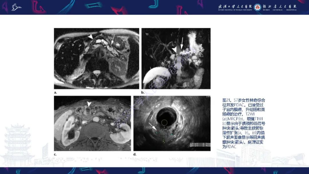 影像PPT - 【PPT】遗传性胃肠肿瘤综合征：影像学在筛查、诊断和治疗中的作用-39
