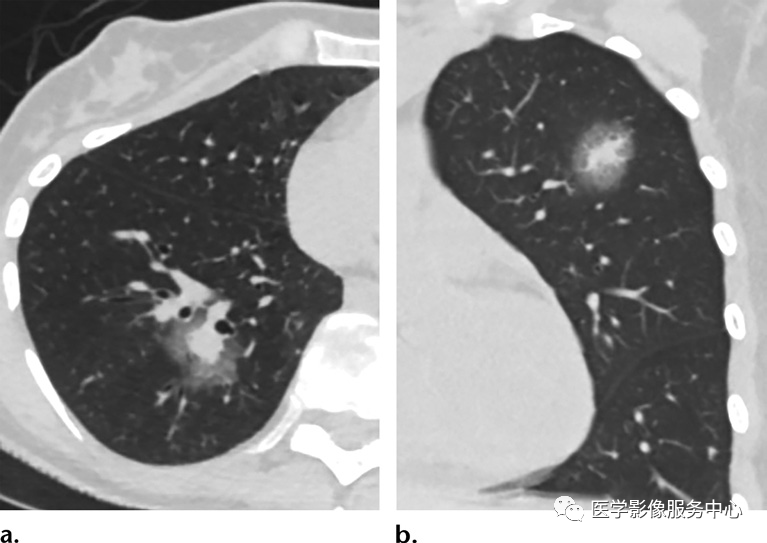 影像PPT - 肺毛霉菌病危险因素、影像学表现及病理对照-4 影像PPT - 肺毛霉菌病危险因素、影像学表现及病理对照-4