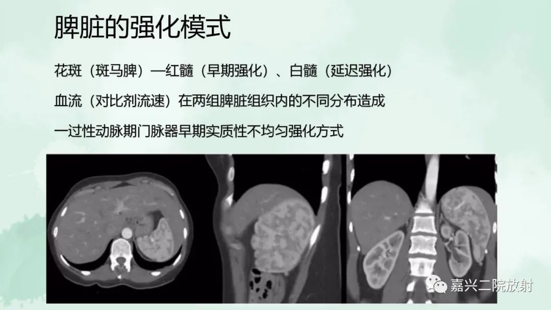 影像PPT - 【PPT】脾脏常见非肿瘤性病变-4