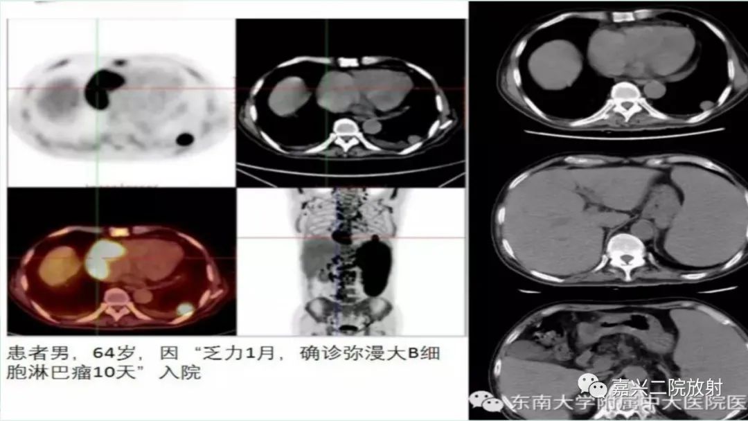 影像PPT - 【PPT】脾脏常见非肿瘤性病变-20