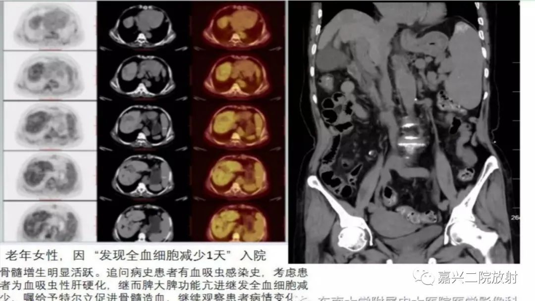 影像PPT - 【PPT】脾脏常见非肿瘤性病变-21