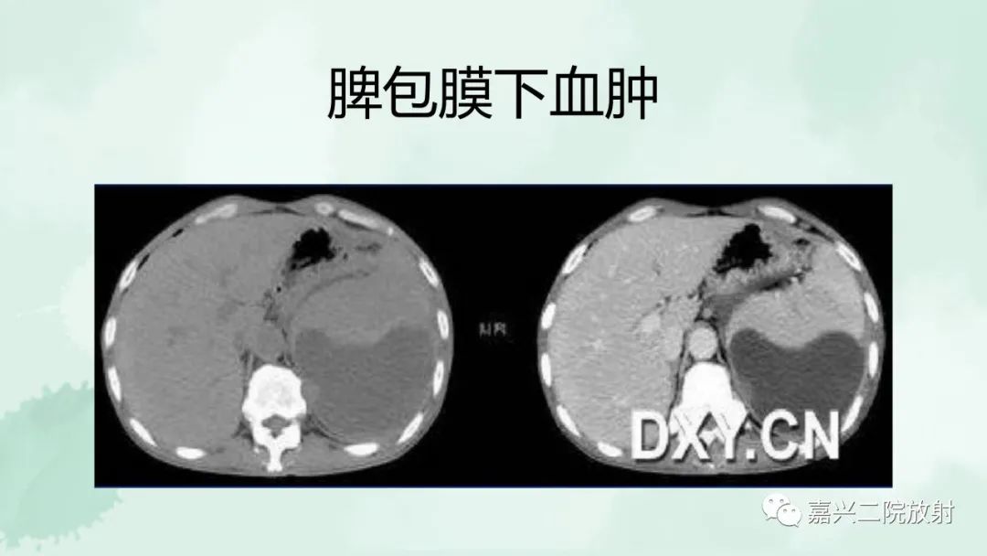 影像PPT - 【PPT】脾脏常见非肿瘤性病变-27