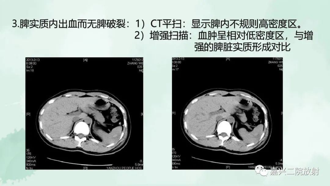 影像PPT - 【PPT】脾脏常见非肿瘤性病变-28