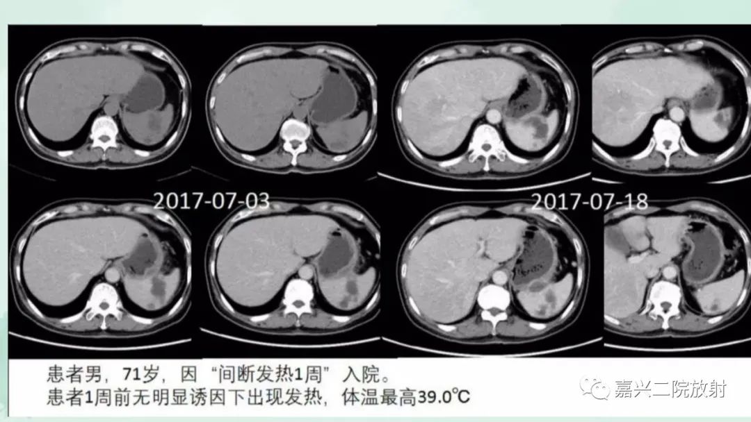 影像PPT - 【PPT】脾脏常见非肿瘤性病变-40