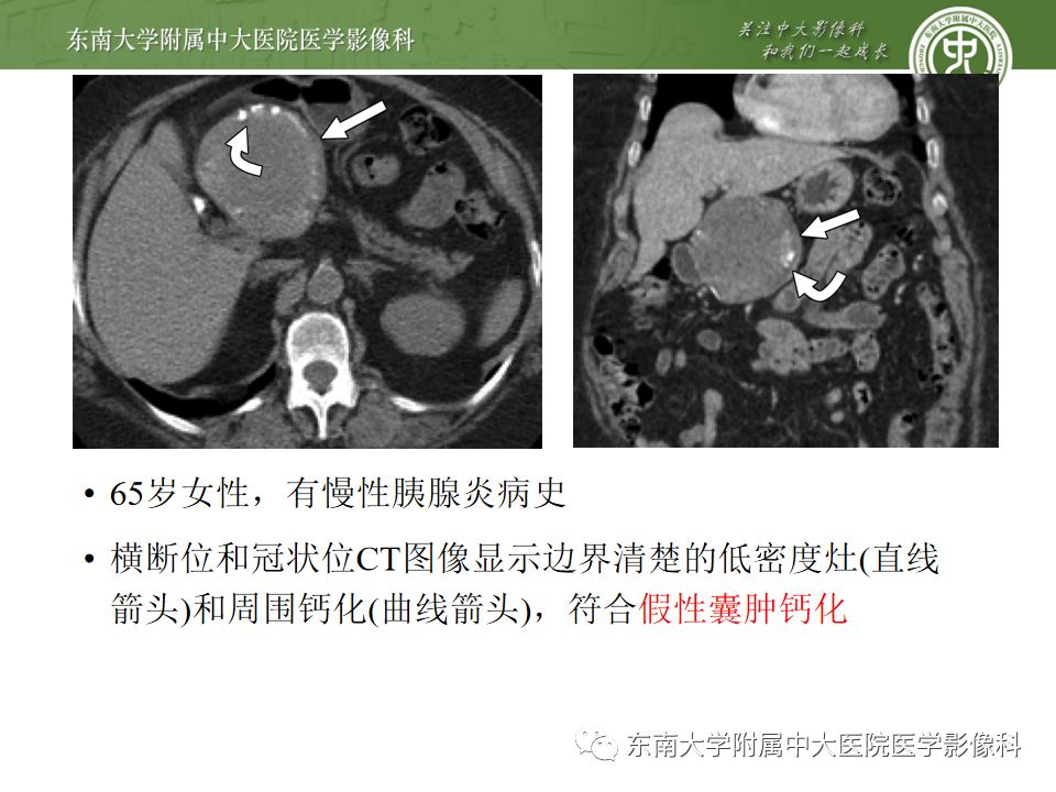 影像PPT - 【PPT】胰腺含钙化肿物的CT鉴别诊断-6
