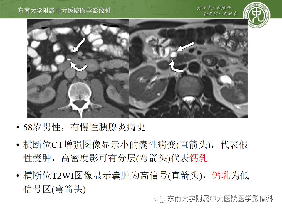 影像PPT - 【PPT】胰腺含钙化肿物的CT鉴别诊断-7
