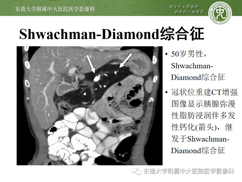 影像PPT - 【PPT】胰腺含钙化肿物的CT鉴别诊断-11