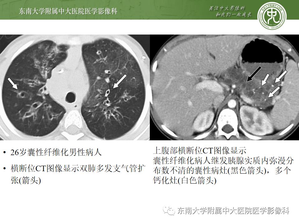 影像PPT - 【PPT】胰腺含钙化肿物的CT鉴别诊断-9