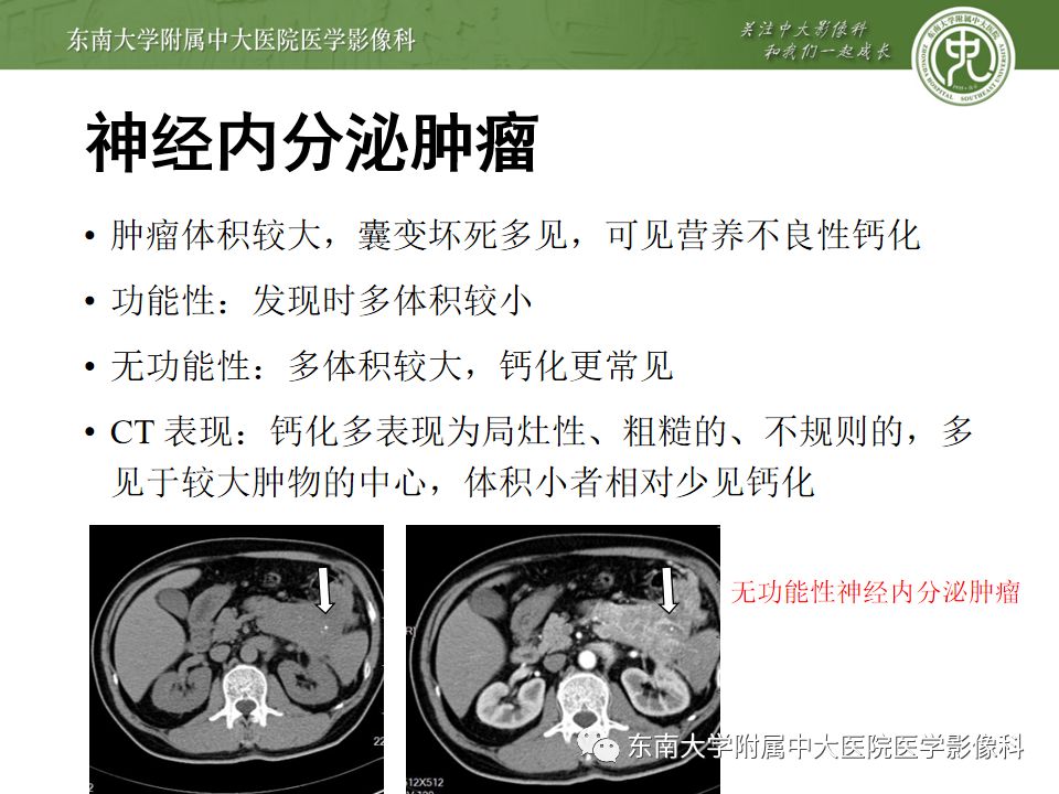 影像PPT - 【PPT】胰腺含钙化肿物的CT鉴别诊断-12