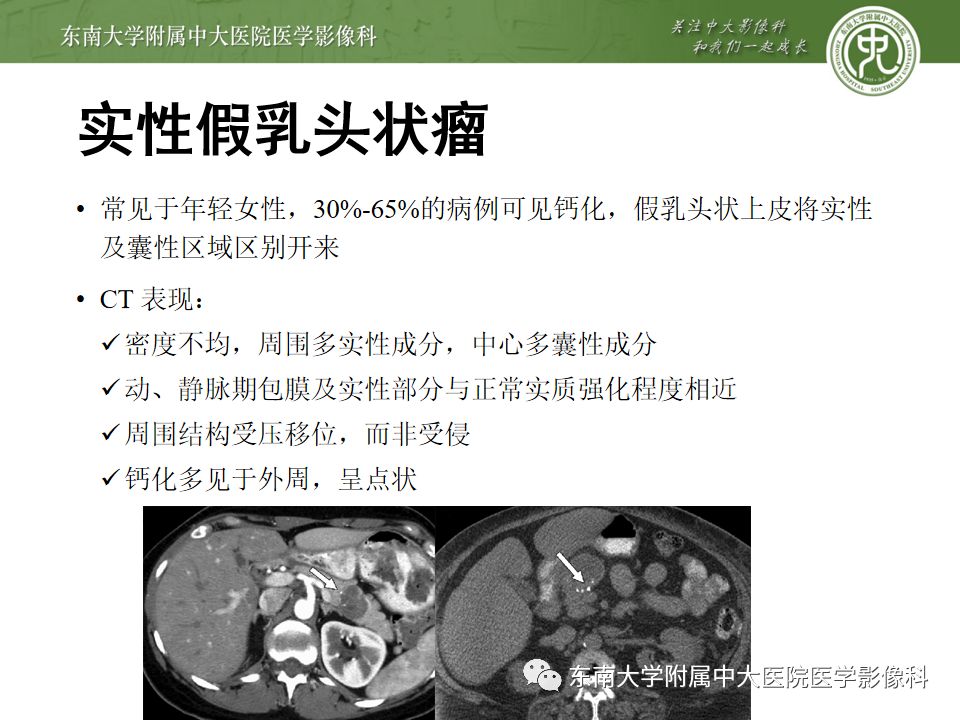 影像PPT - 【PPT】胰腺含钙化肿物的CT鉴别诊断-16