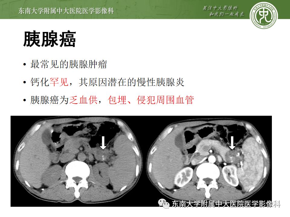 影像PPT - 【PPT】胰腺含钙化肿物的CT鉴别诊断-13
