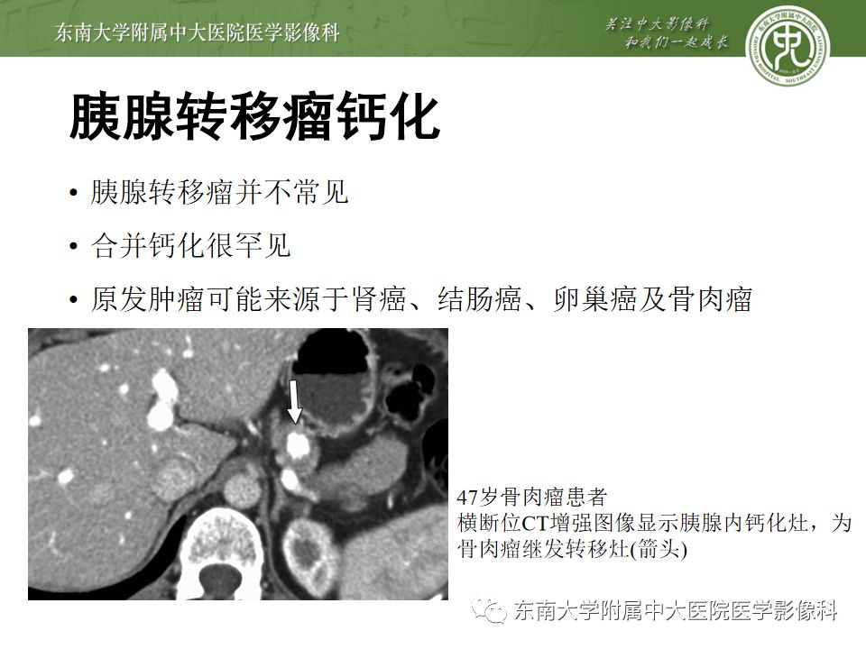 影像PPT - 【PPT】胰腺含钙化肿物的CT鉴别诊断-14