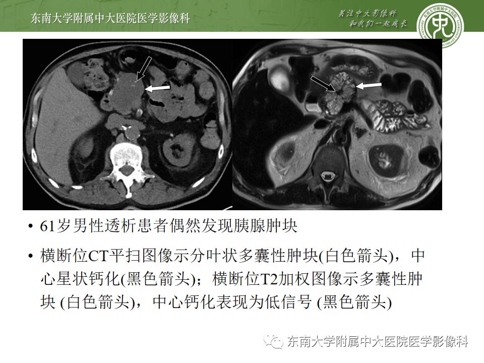 影像PPT - 【PPT】胰腺含钙化肿物的CT鉴别诊断-18
