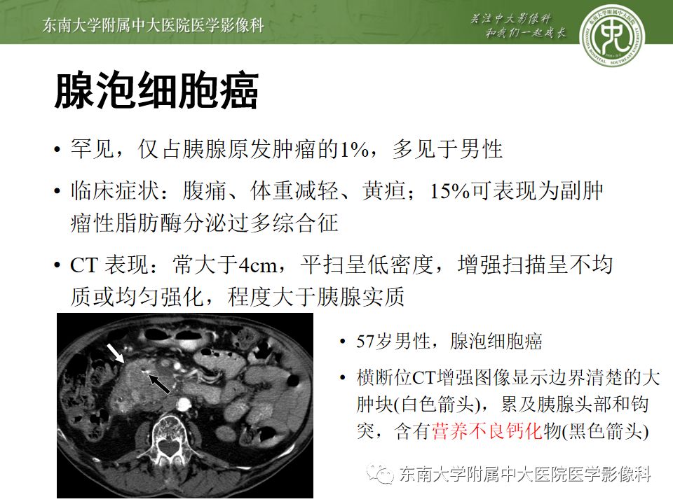 影像PPT - 【PPT】胰腺含钙化肿物的CT鉴别诊断-15