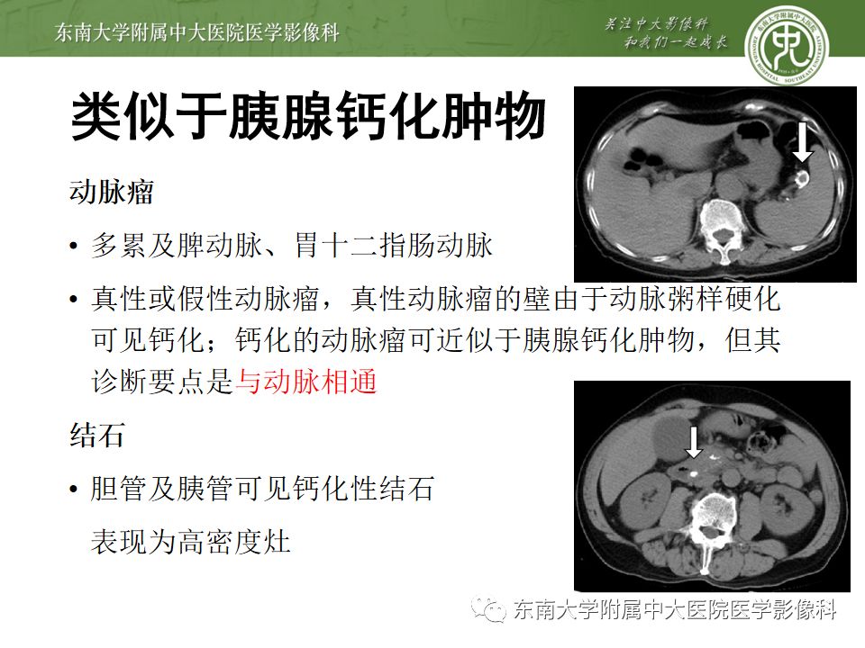 影像PPT - 【PPT】胰腺含钙化肿物的CT鉴别诊断-22