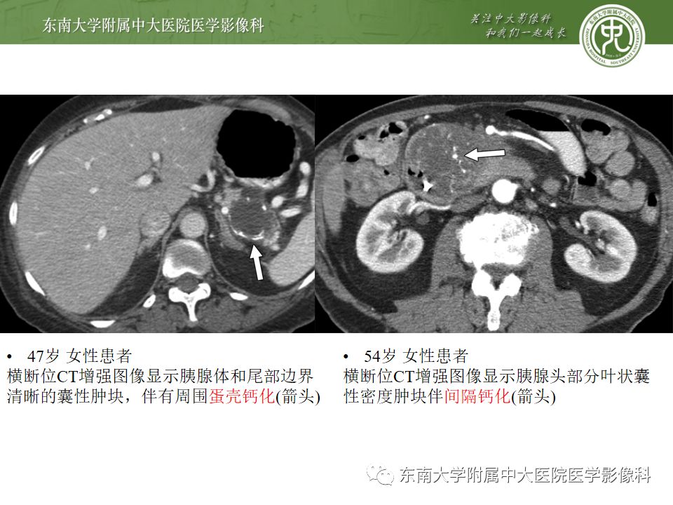 影像PPT - 【PPT】胰腺含钙化肿物的CT鉴别诊断-20