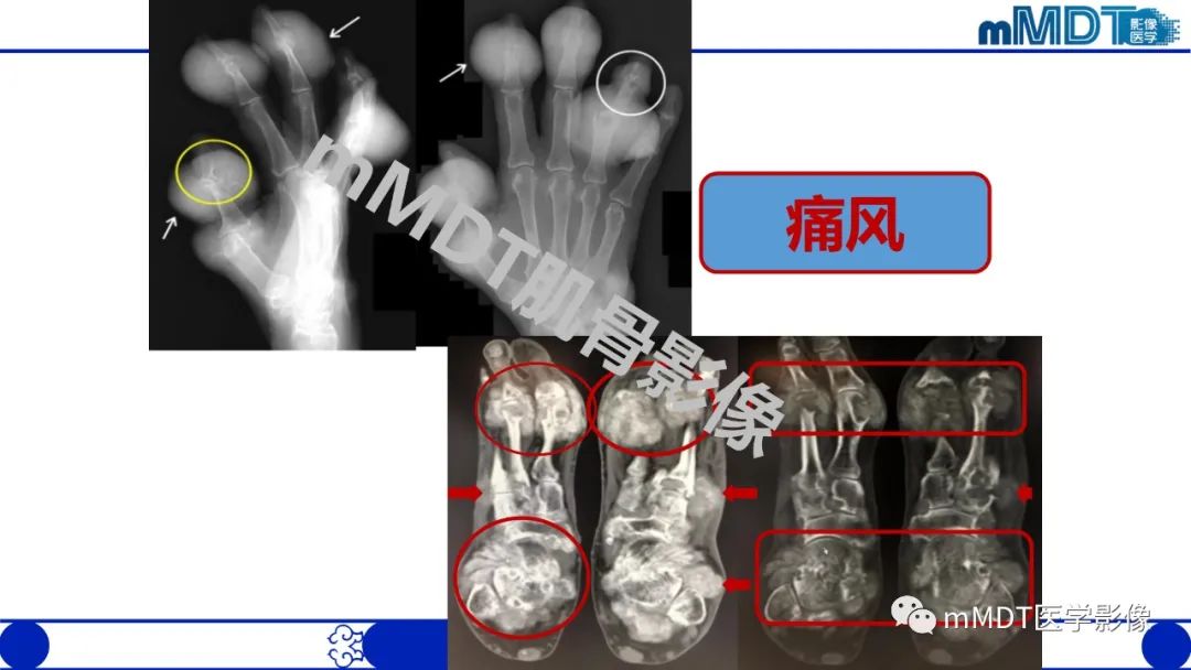 影像PPT - 【PPT】浅析软组织高密度影-7 影像PPT - 【PPT】浅析软组织高密度影-7