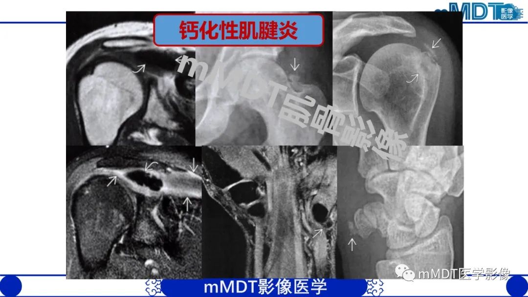 影像PPT - 【PPT】浅析软组织高密度影-11 影像PPT - 【PPT】浅析软组织高密度影-11
