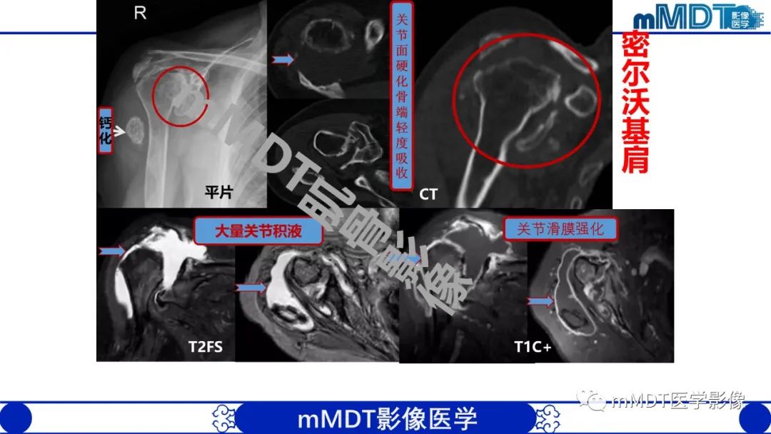 影像PPT - 【PPT】浅析软组织高密度影-12 影像PPT - 【PPT】浅析软组织高密度影-12