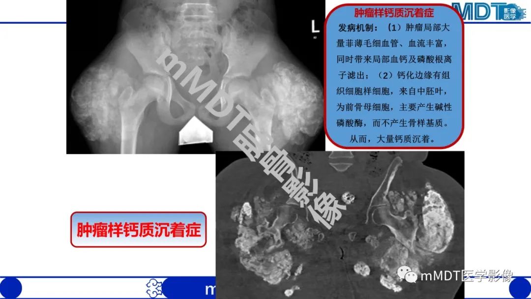 影像PPT - 【PPT】浅析软组织高密度影-14 影像PPT - 【PPT】浅析软组织高密度影-14