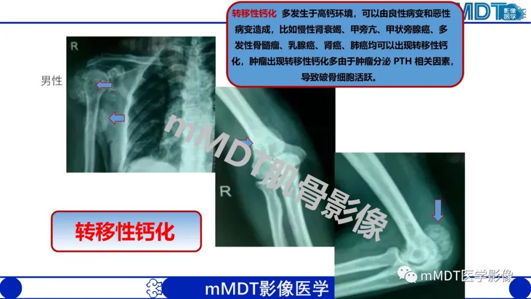 影像PPT - 【PPT】浅析软组织高密度影-13 影像PPT - 【PPT】浅析软组织高密度影-13