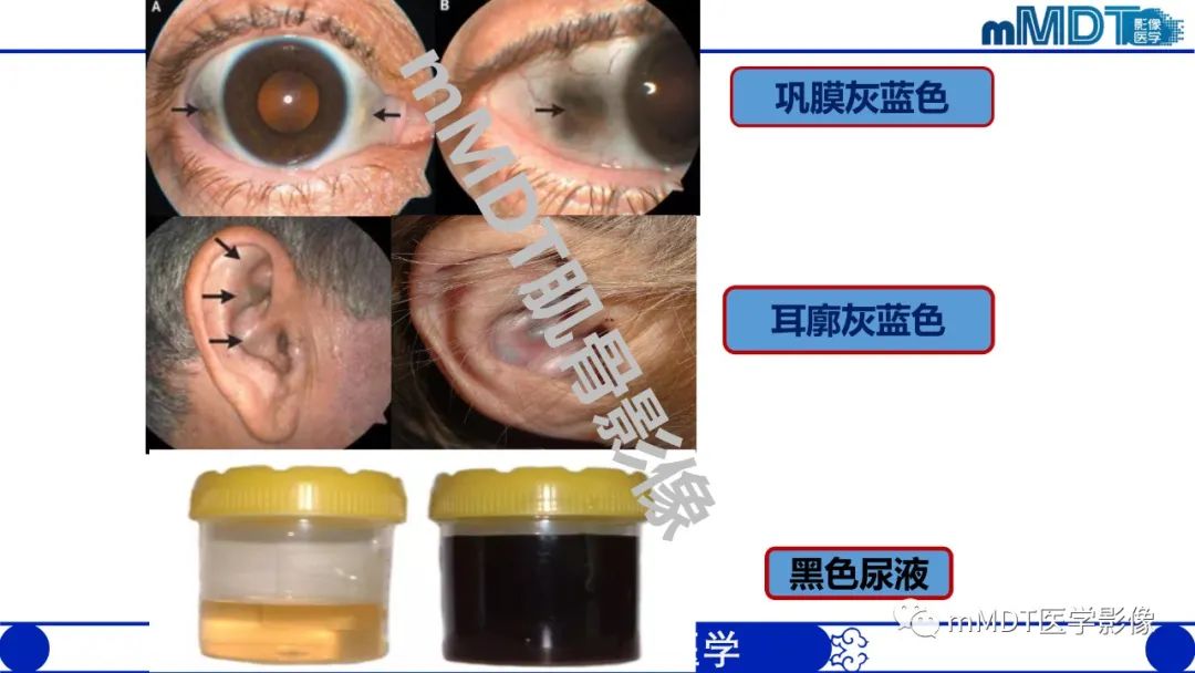影像PPT - 【PPT】浅析软组织高密度影-16 影像PPT - 【PPT】浅析软组织高密度影-16