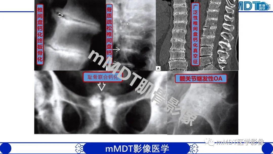 影像PPT - 【PPT】浅析软组织高密度影-17 影像PPT - 【PPT】浅析软组织高密度影-17