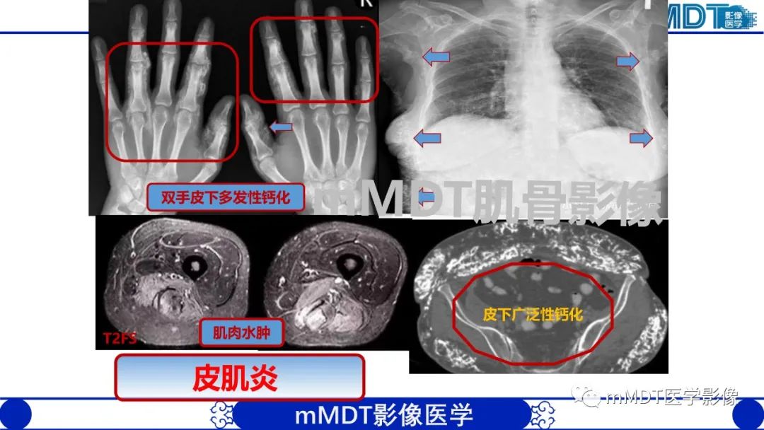 影像PPT - 【PPT】浅析软组织高密度影-20 影像PPT - 【PPT】浅析软组织高密度影-20