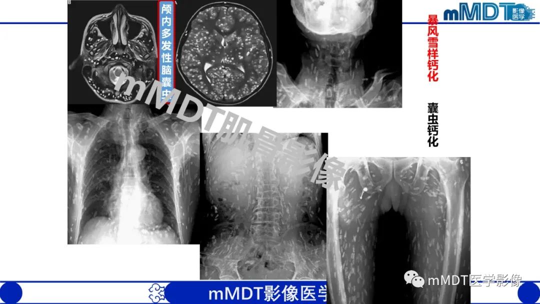 影像PPT - 【PPT】浅析软组织高密度影-22 影像PPT - 【PPT】浅析软组织高密度影-22
