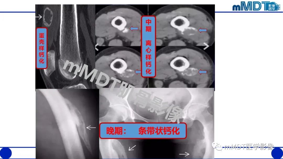 影像PPT - 【PPT】浅析软组织高密度影-24 影像PPT - 【PPT】浅析软组织高密度影-24