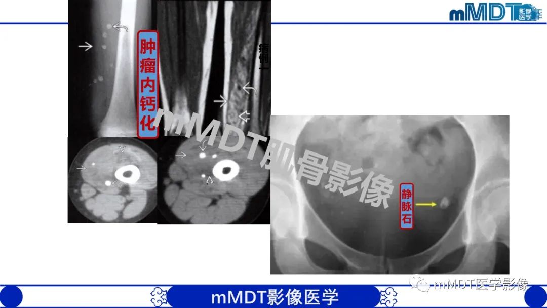 影像PPT - 【PPT】浅析软组织高密度影-26 影像PPT - 【PPT】浅析软组织高密度影-26