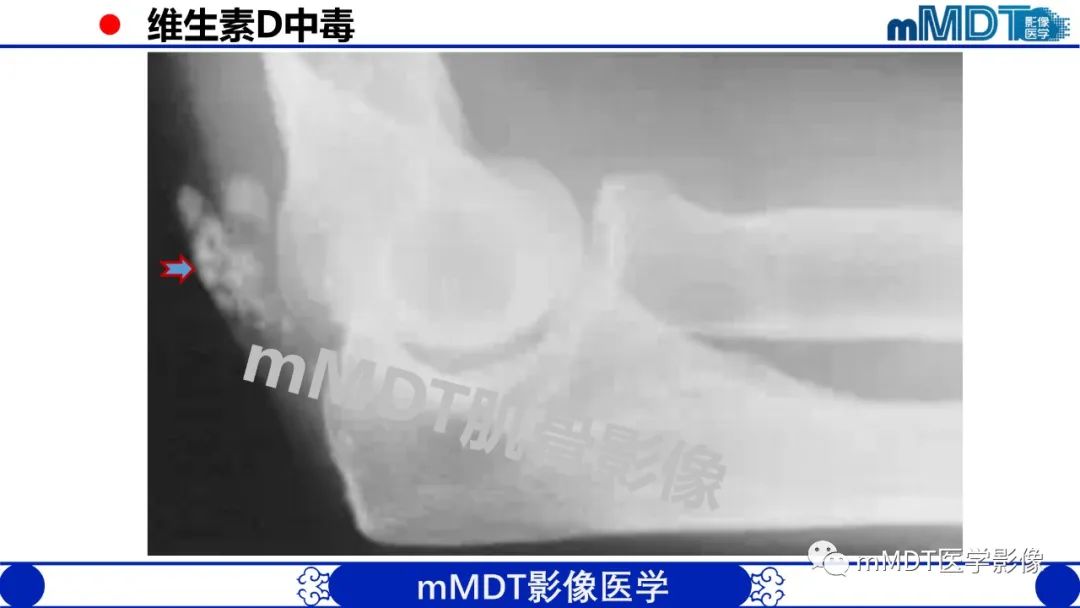 影像PPT - 【PPT】浅析软组织高密度影-27 影像PPT - 【PPT】浅析软组织高密度影-27