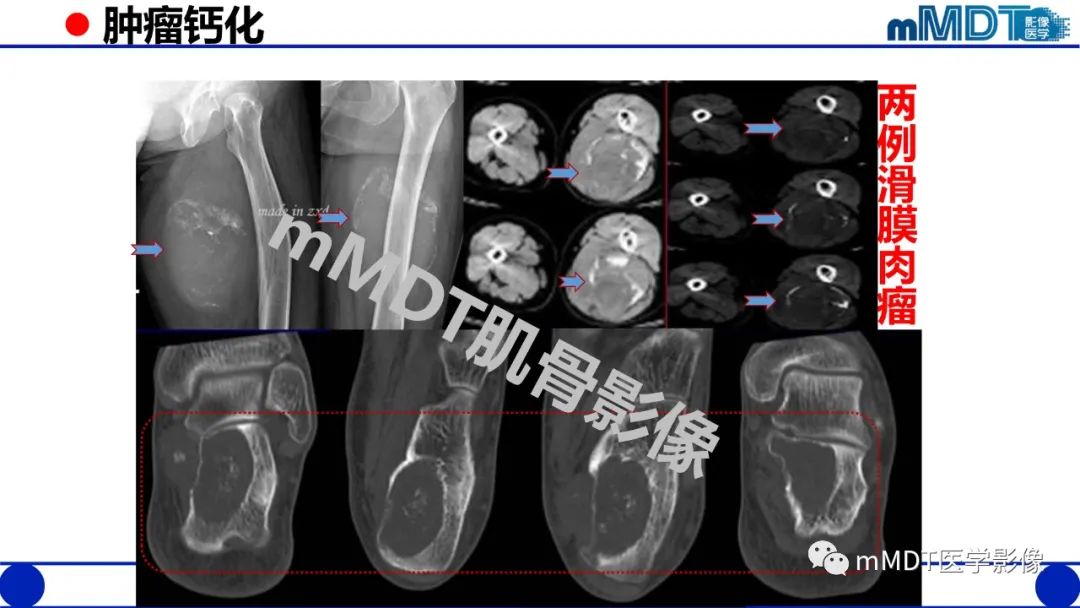 影像PPT - 【PPT】浅析软组织高密度影-28 影像PPT - 【PPT】浅析软组织高密度影-28
