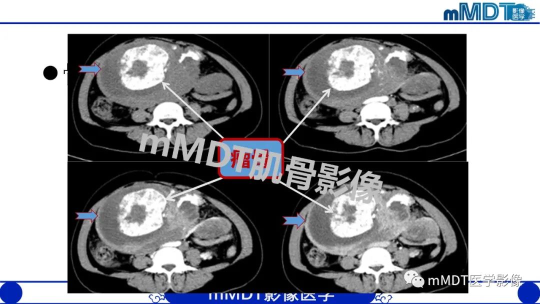 影像PPT - 【PPT】浅析软组织高密度影-30 影像PPT - 【PPT】浅析软组织高密度影-30