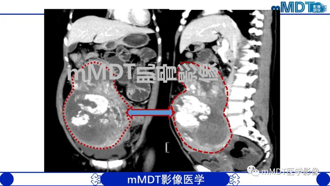 影像PPT - 【PPT】浅析软组织高密度影-31 影像PPT - 【PPT】浅析软组织高密度影-31