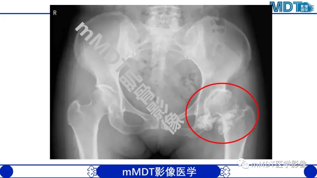 影像PPT - 【PPT】浅析软组织高密度影-32 影像PPT - 【PPT】浅析软组织高密度影-32
