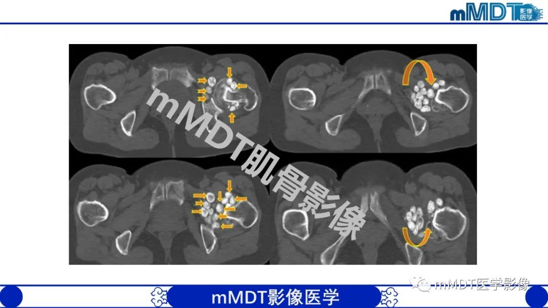 影像PPT - 【PPT】浅析软组织高密度影-33 影像PPT - 【PPT】浅析软组织高密度影-33