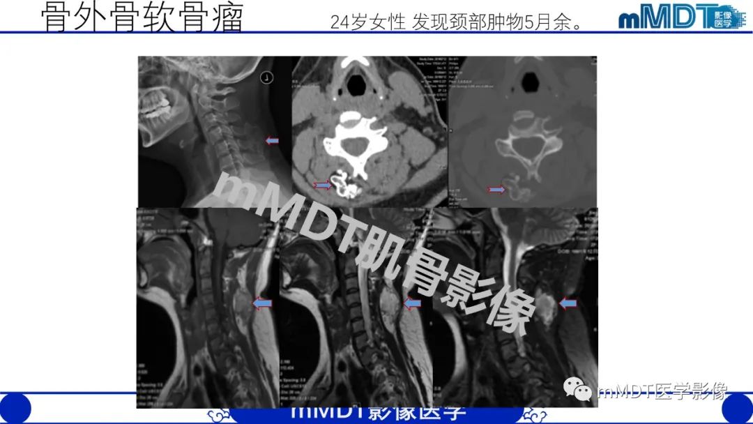 影像PPT - 【PPT】浅析软组织高密度影-34 影像PPT - 【PPT】浅析软组织高密度影-34