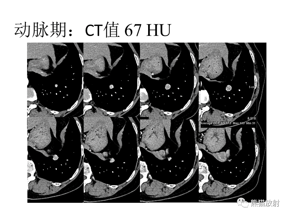 影像PPT - 【病例】肺浸润性腺癌2例CT影像-4