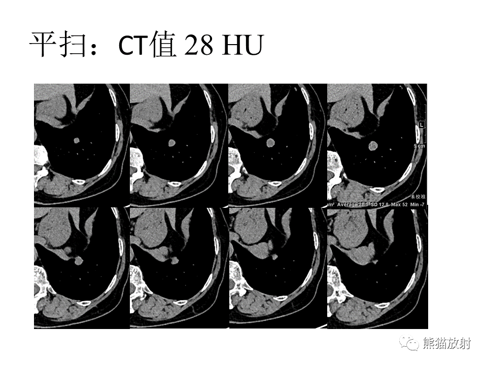 影像PPT - 【病例】肺浸润性腺癌2例CT影像-3
