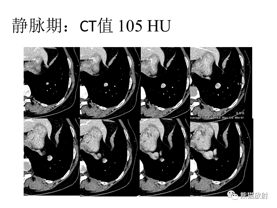 影像PPT - 【病例】肺浸润性腺癌2例CT影像-5