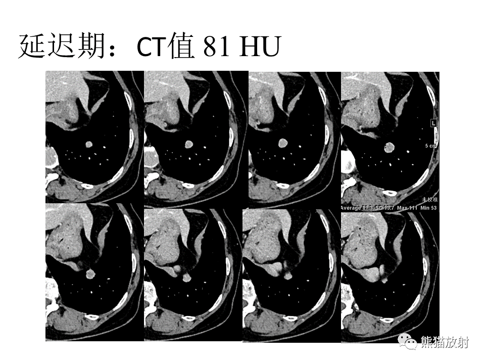 影像PPT - 【病例】肺浸润性腺癌2例CT影像-6