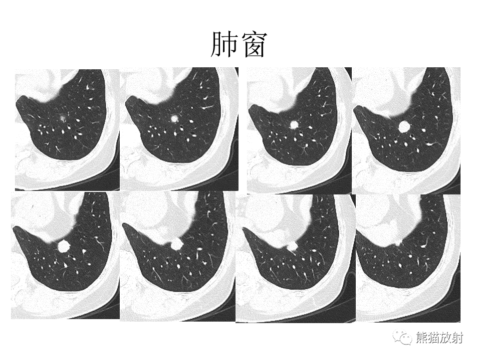 影像PPT - 【病例】肺浸润性腺癌2例CT影像-7