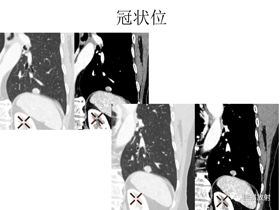 影像PPT - 【病例】肺浸润性腺癌2例CT影像-8